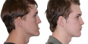 Corrective Jaw Surgery
