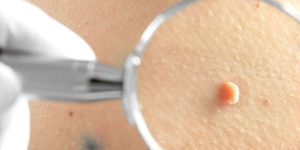 Moles Removal in Dubai
